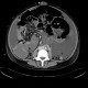 Variceal bleeding, Segstaken tube, liver cirrhosis, portal hypertension, varices, ascites, rectal tube: CT - Computed tomography